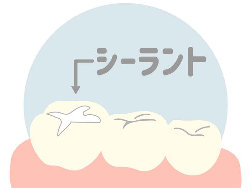 シーラント処置