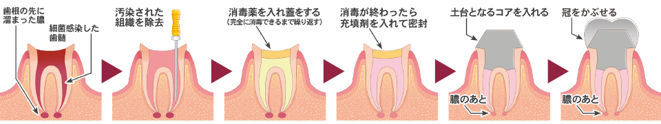 根管治療の流れ