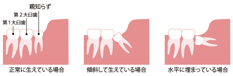 親知らずのパターン