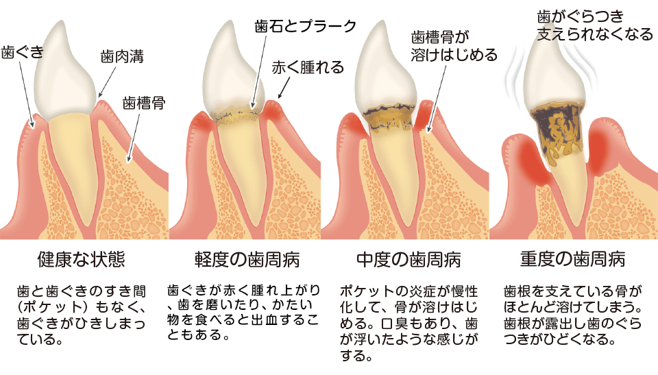 歯周病の進行